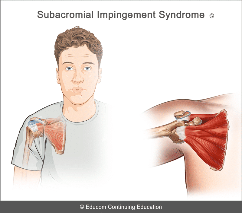 Subacromial Impingement Syndrome Diagnosis Management