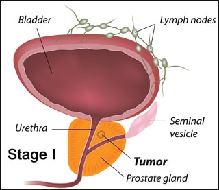 Unit 1 - Prostate cancer metastasis presenting as low back pain ...