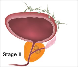 Unit 1 - Prostate cancer metastasis presenting as low back pain ...