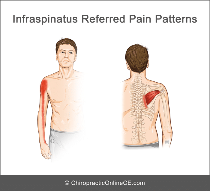 Unit 2 - Infraspinatus Myofascial Pain Syndrome@LIFEWEST-Sports-V1-U2 ...