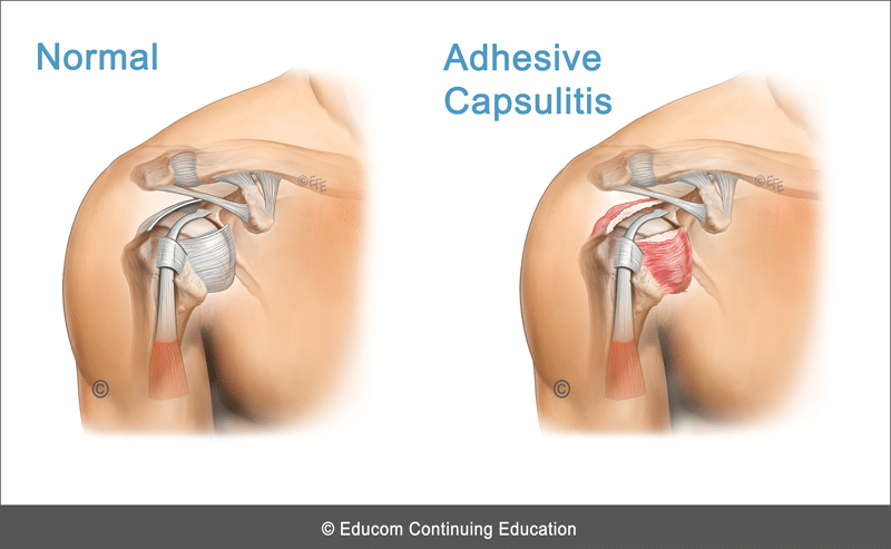 Unit Adhesive Capsulitis Frozen Shoulder Lifewest Msd V U