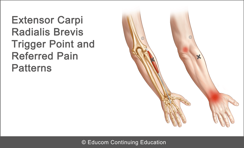 Unit Extensor Carpi Radialis Brevis Myofascial Pain Syndrome Lifewest Msd V U